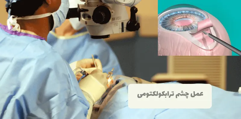 عمل ترابکولکتومی