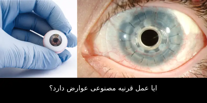 قرنیه مصنوعی چیست؟