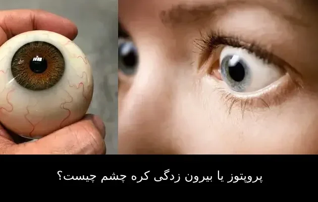 پروپتوز یا بیرون زدگی کره چشم