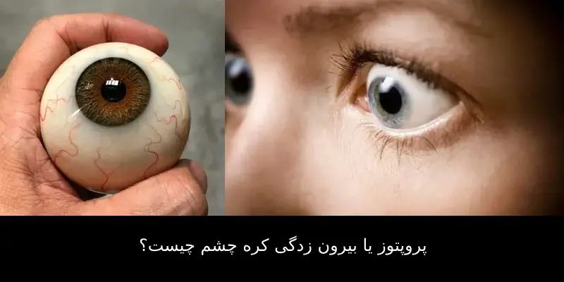 پروپتوز یا بیرون زدگی کره چشم