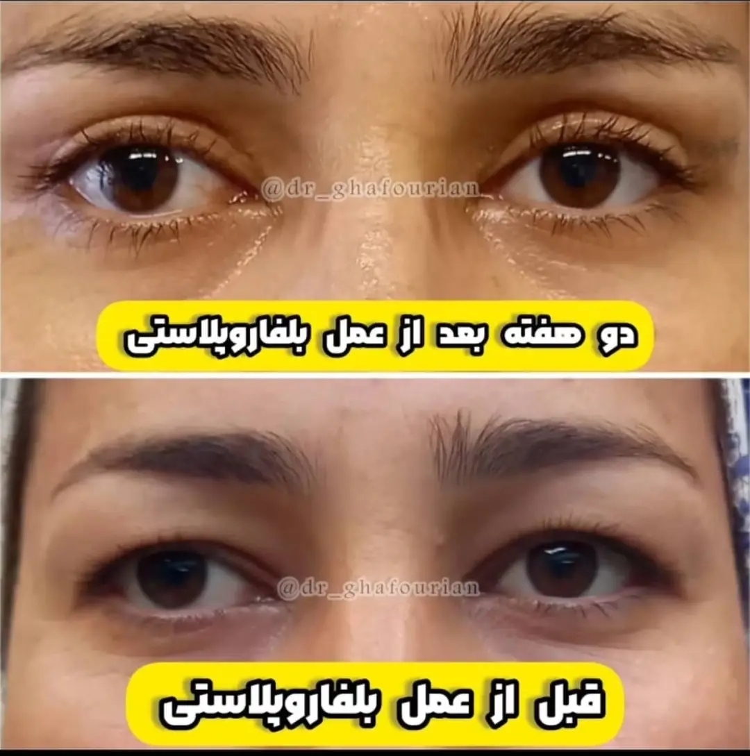 عمل زیبایی بلفاروپلاستی توسط فوق تخصص چشم