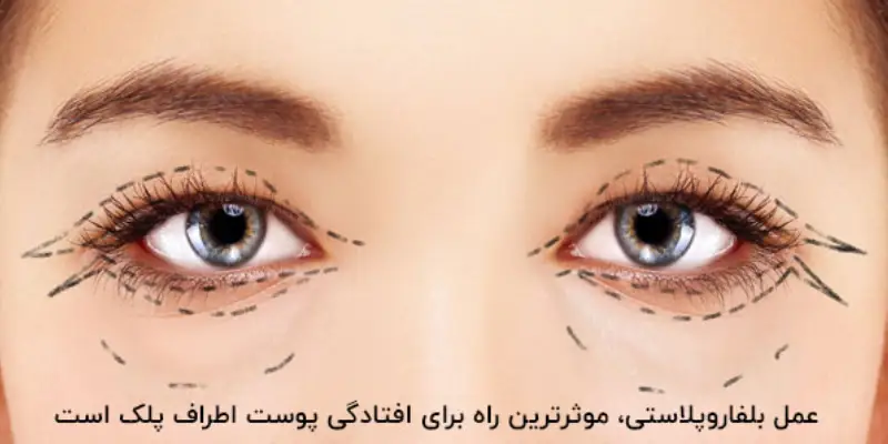 نحوه انجام عمل بلفاروپلاستی