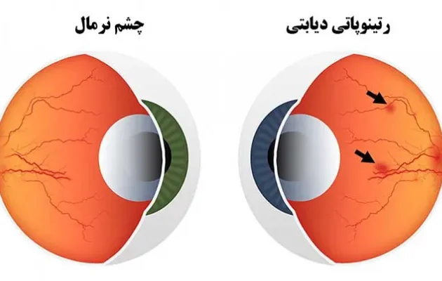 دیابت و تأثیر آن بر سلامت چشم