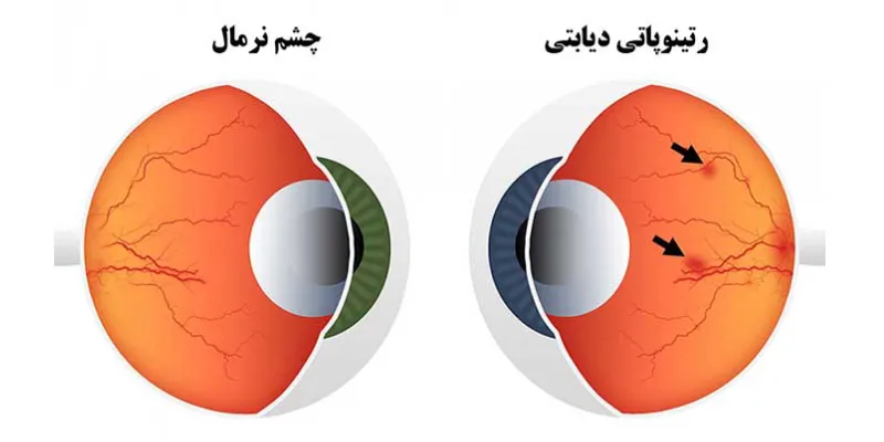 دیابت و تأثیر آن بر سلامت چشم