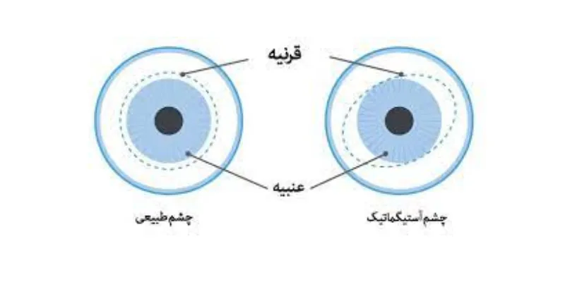 تشخیص آستیگماتیسم