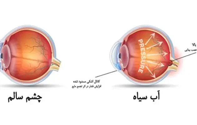 آیا آب سیاه چشم باعث نابینایی می‌شود؟
