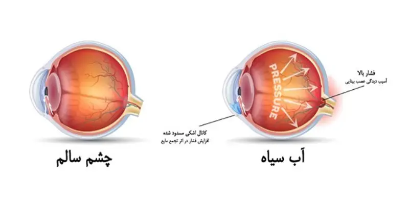 آیا آب سیاه چشم باعث نابینایی می‌شود؟